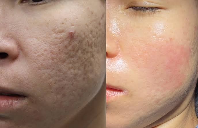 Acne Scar Reduction