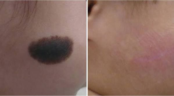 Birthmark Removal