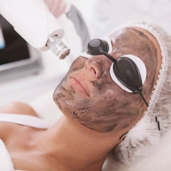 Carbon Peel