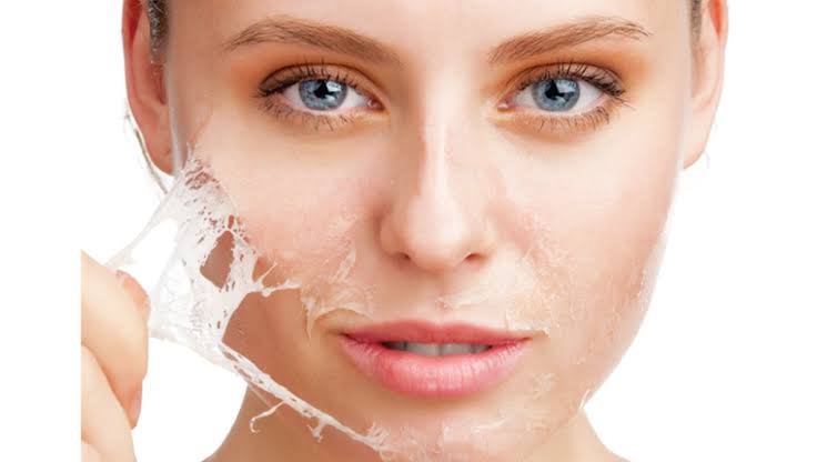 Chemical Peel