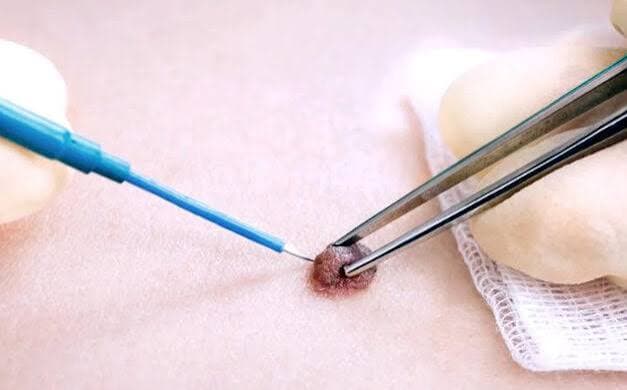 Electrocautery Treatment