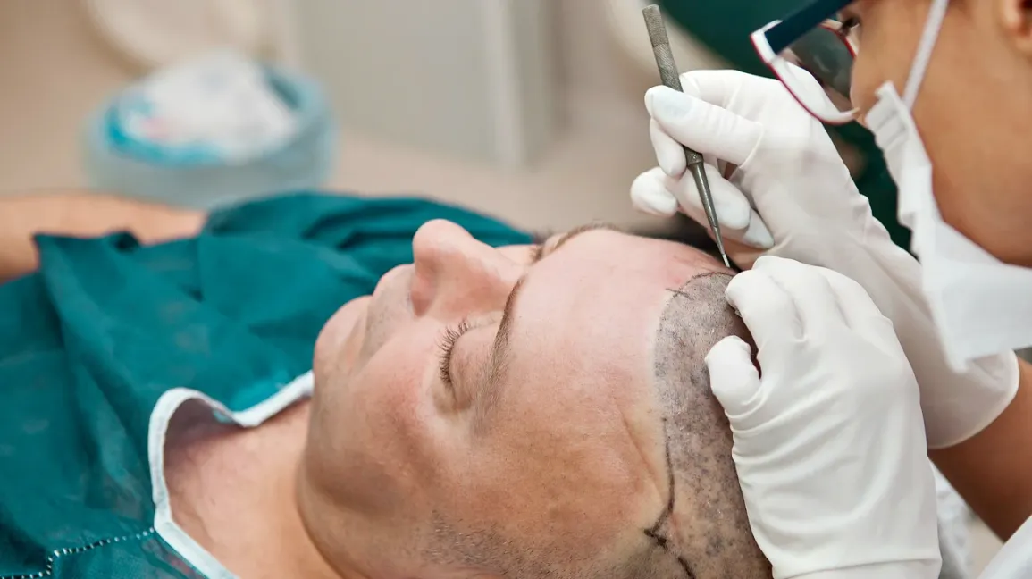Hair Transplant