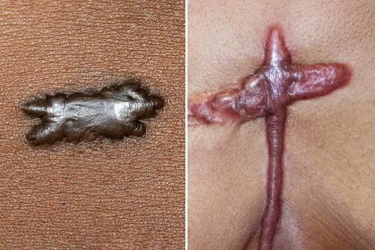 Keloid Treatment