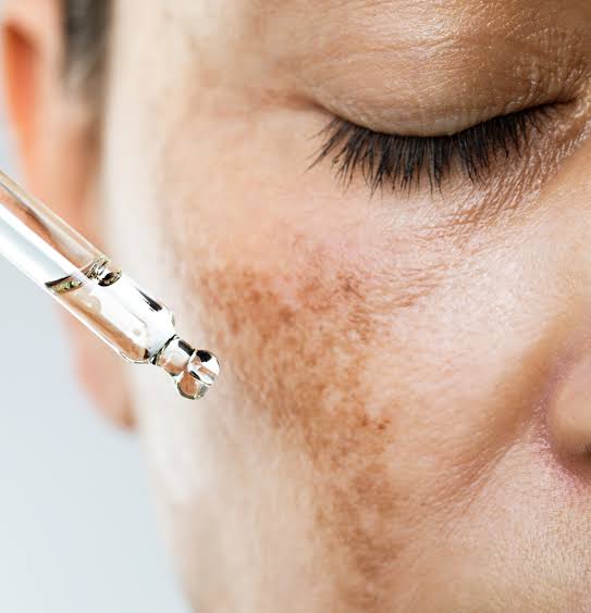 Melasma Treatment