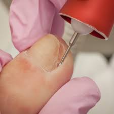 Nail Surgery
