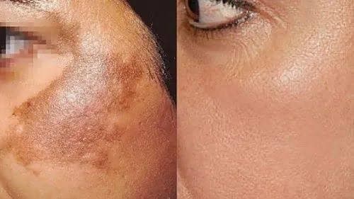 Pigmentation Treatment
