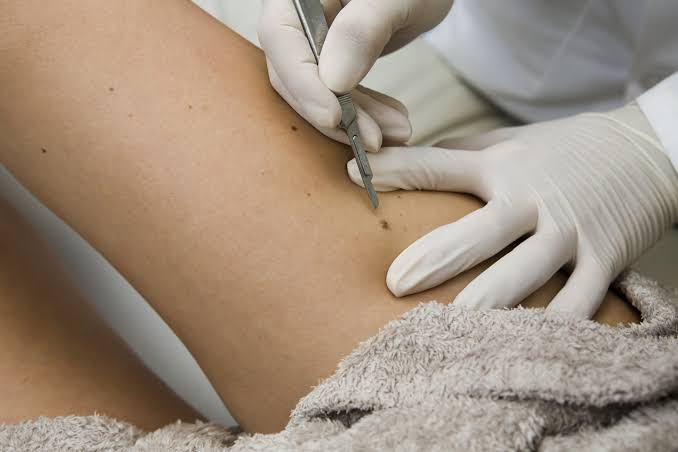 Skin Biopsy