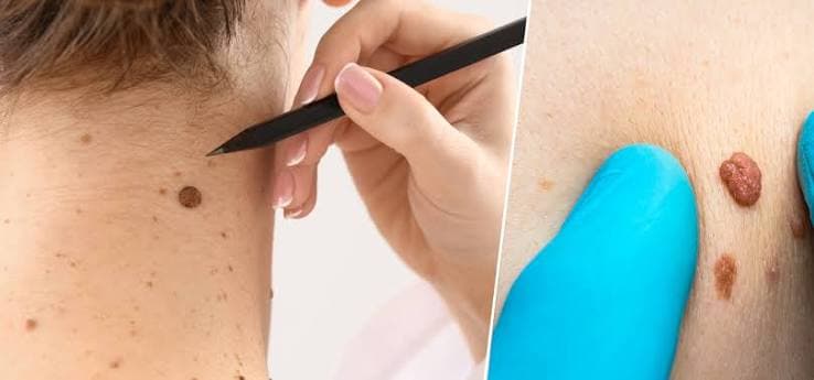 Skin Tags & Mole Removal