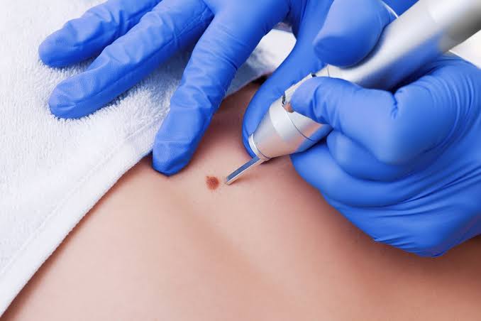 Skin Tags Removal