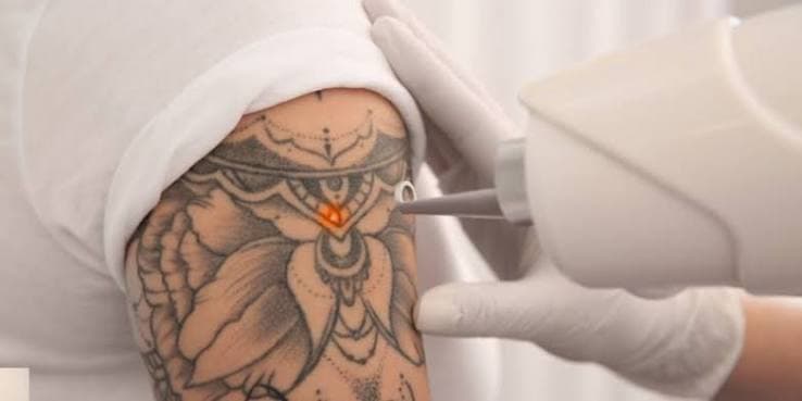 Tattoo Removal