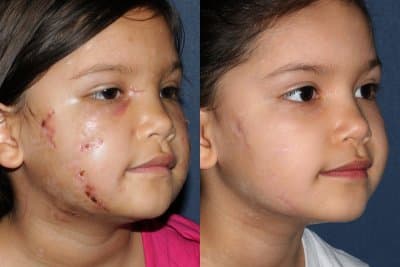 Traumatic Scar Treatment