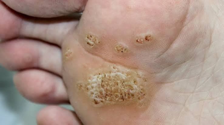 Warts Removal